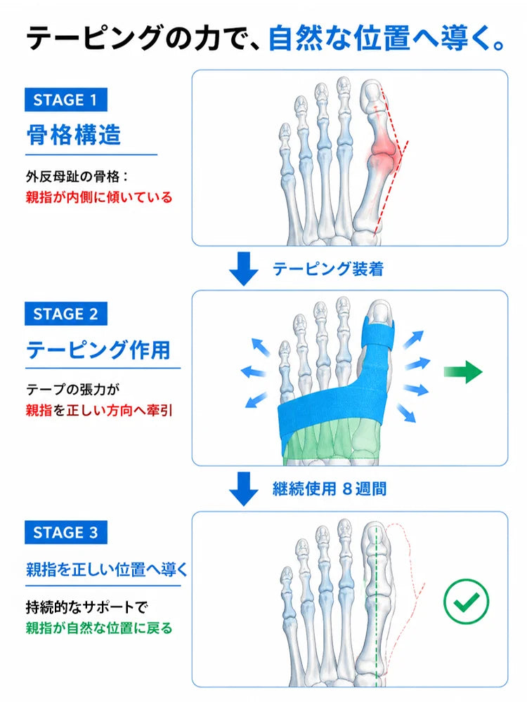 外反母趾サポーター足指サポートバンド