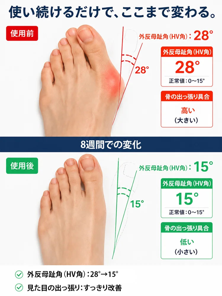 外反母趾サポーター足指サポートバンド